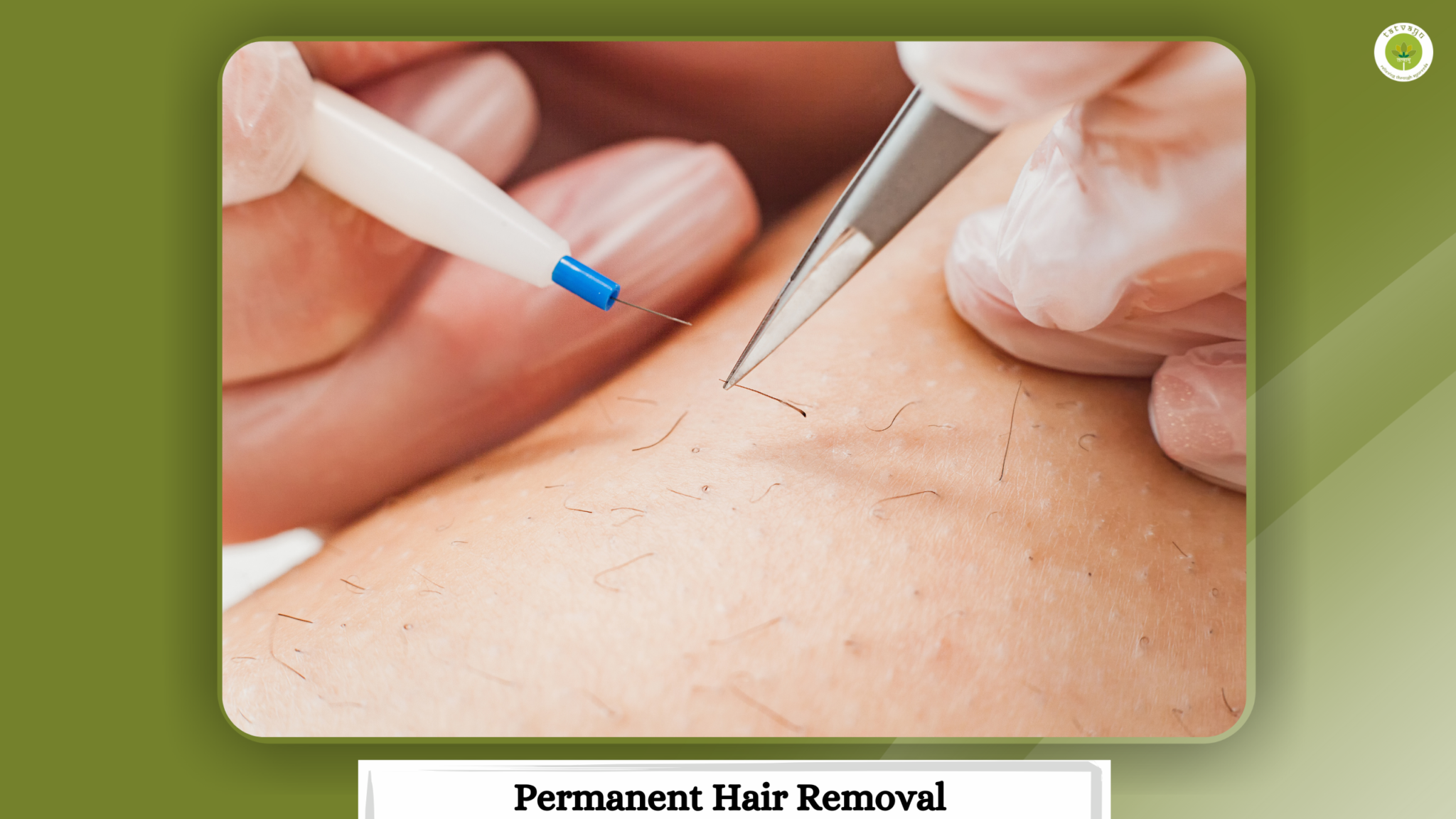 Permanent Hair Removal treatments in Vadodara