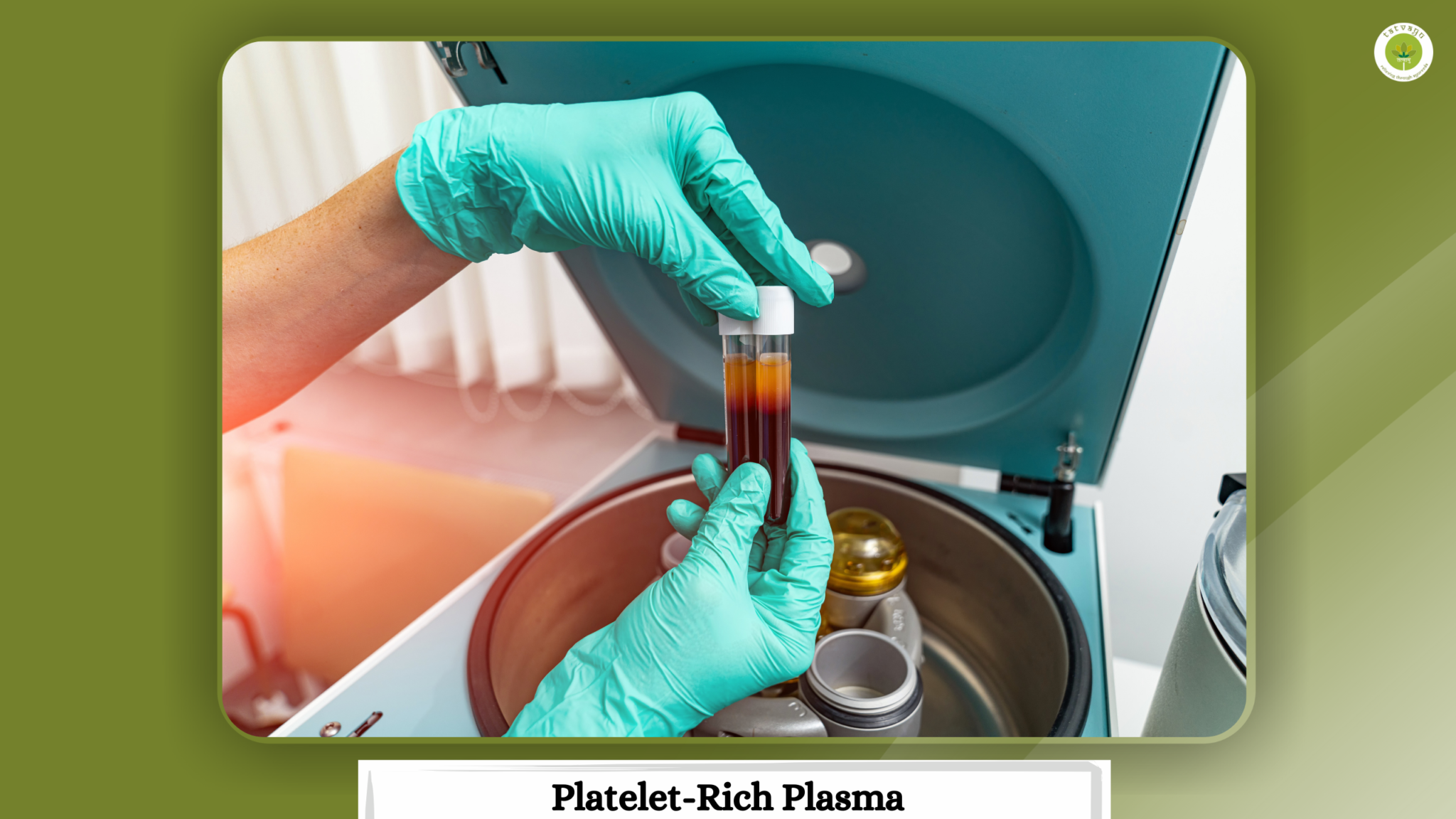 PRP treatment in vadodara